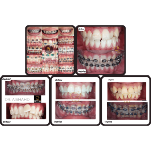 conventional-braces-dentalwise-care-clinic