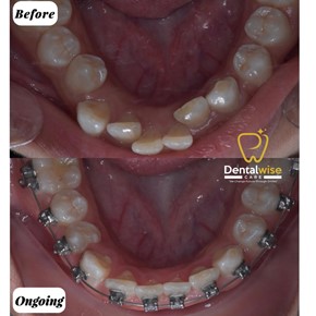 Read more about the article Self-Ligating & Ceramic Self-Ligating
